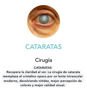 CATARATAS